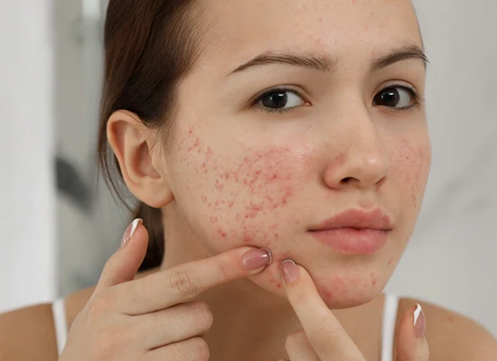Acne-Prone Skin