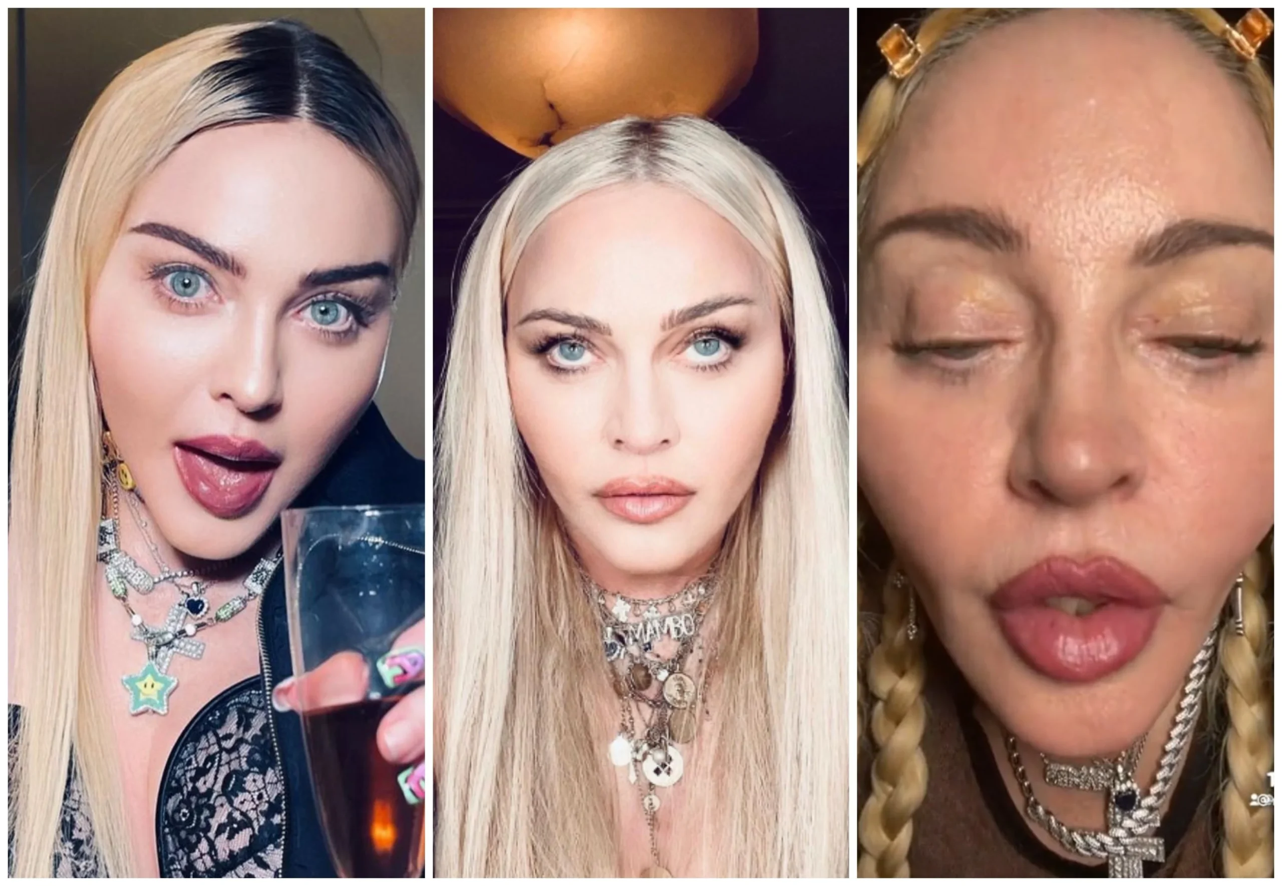 Madonna Plastic Surgery
